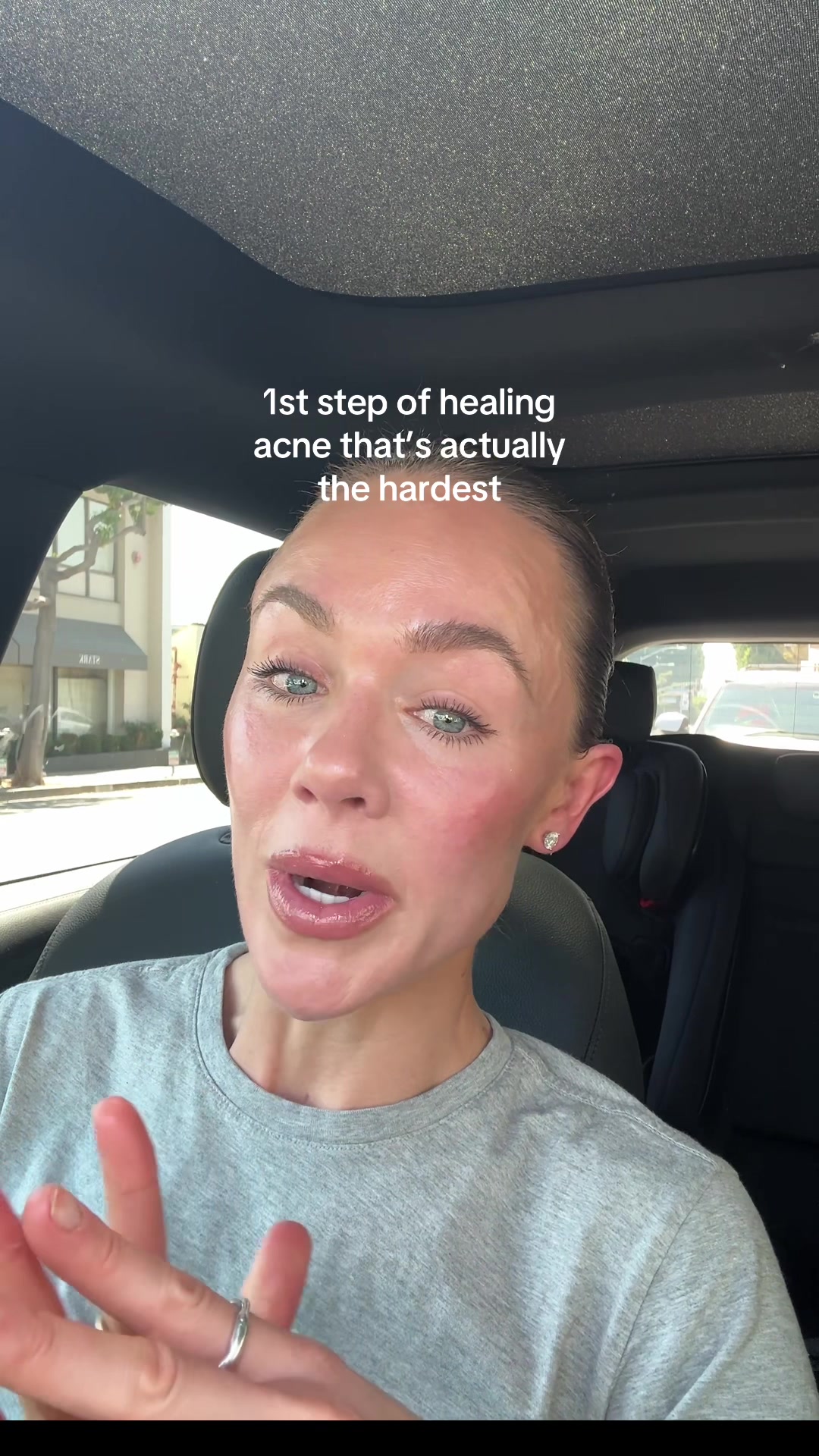 @Celeste | RN acne expert