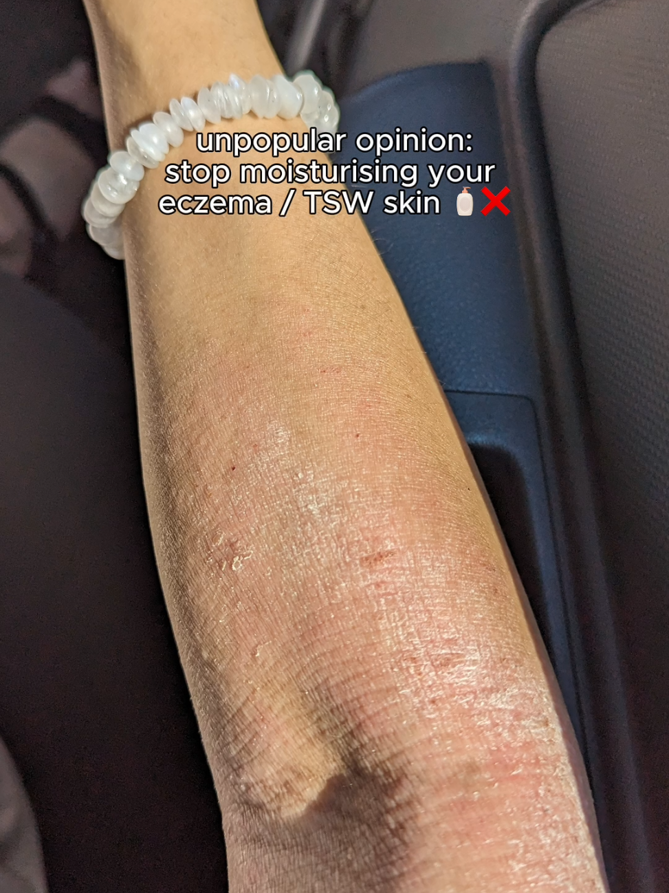 @Grace | TSW & Eczema Recovery