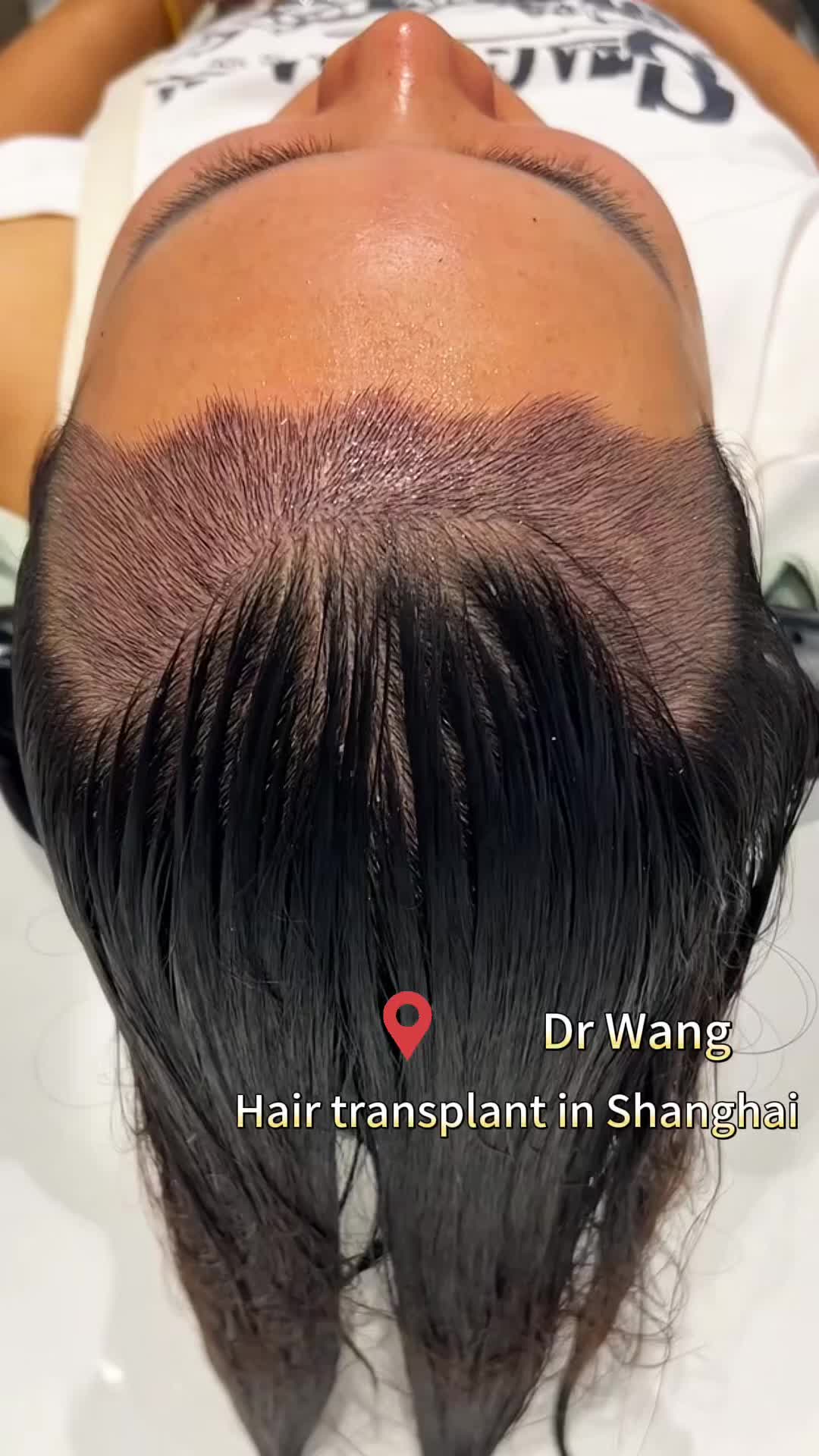 @HAIR TRANSPLANT WANG🇨🇳