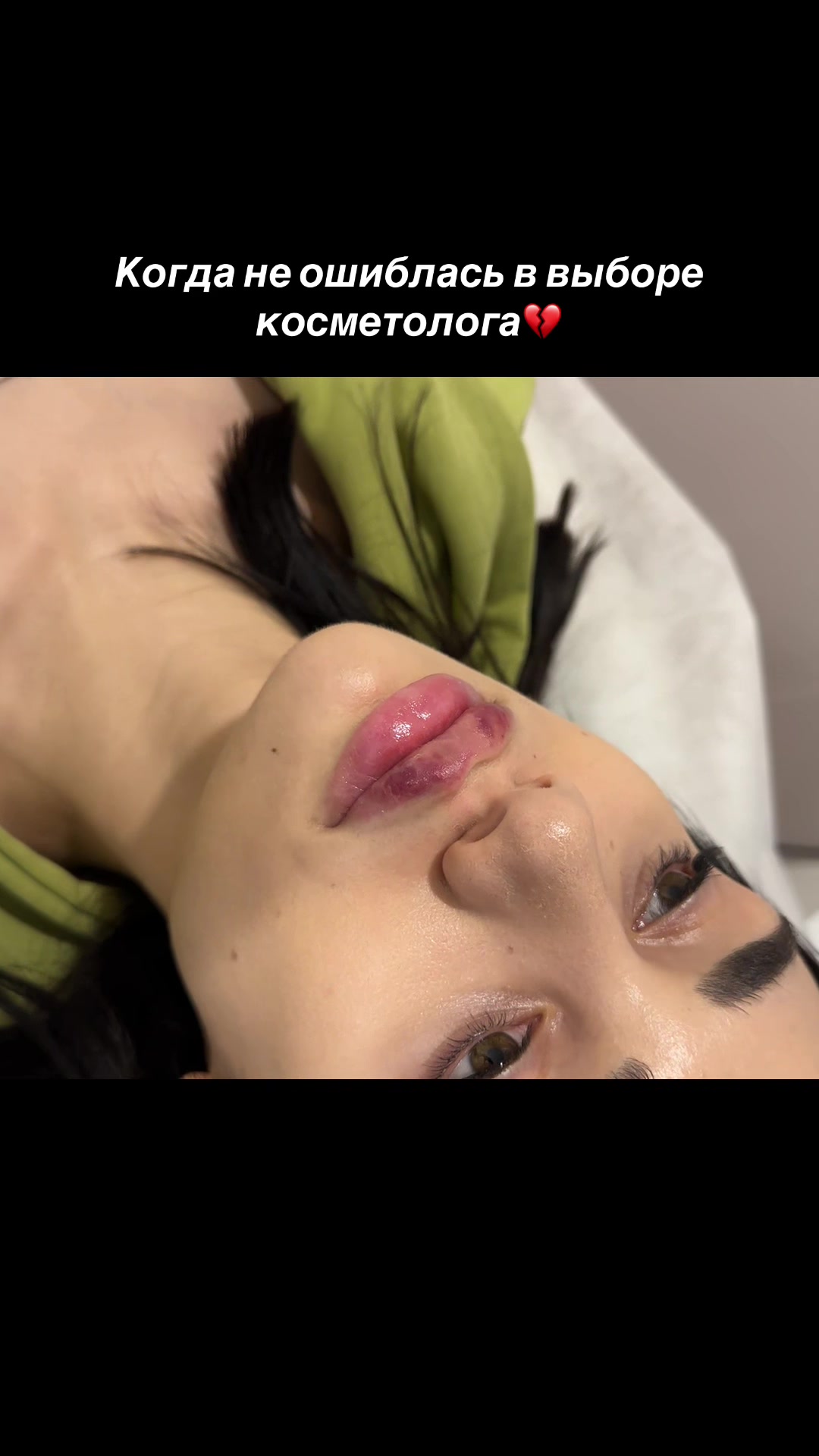 @КОСМЕТОЛОГ • УВЕЛИЧЕНИЕ ГУБ
