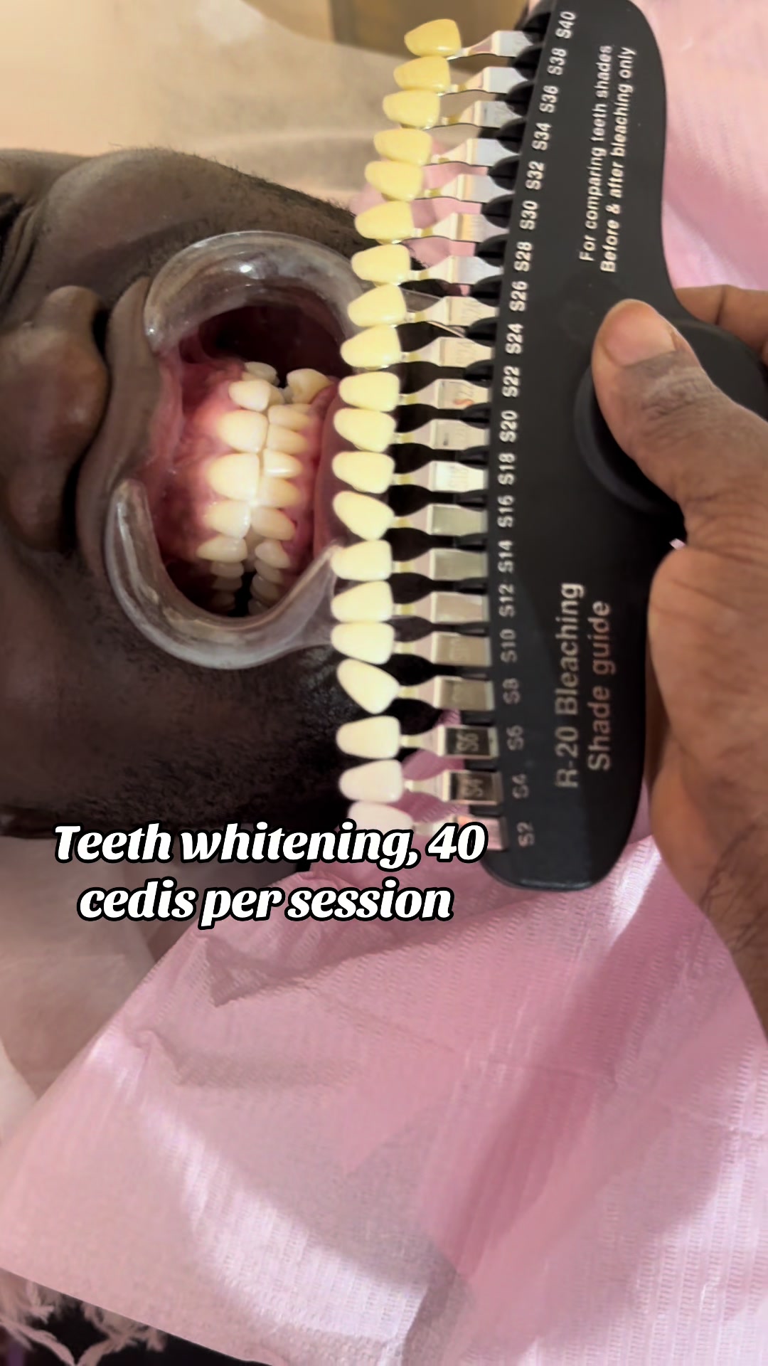 @Teethwhitening—MartGlow Avenue