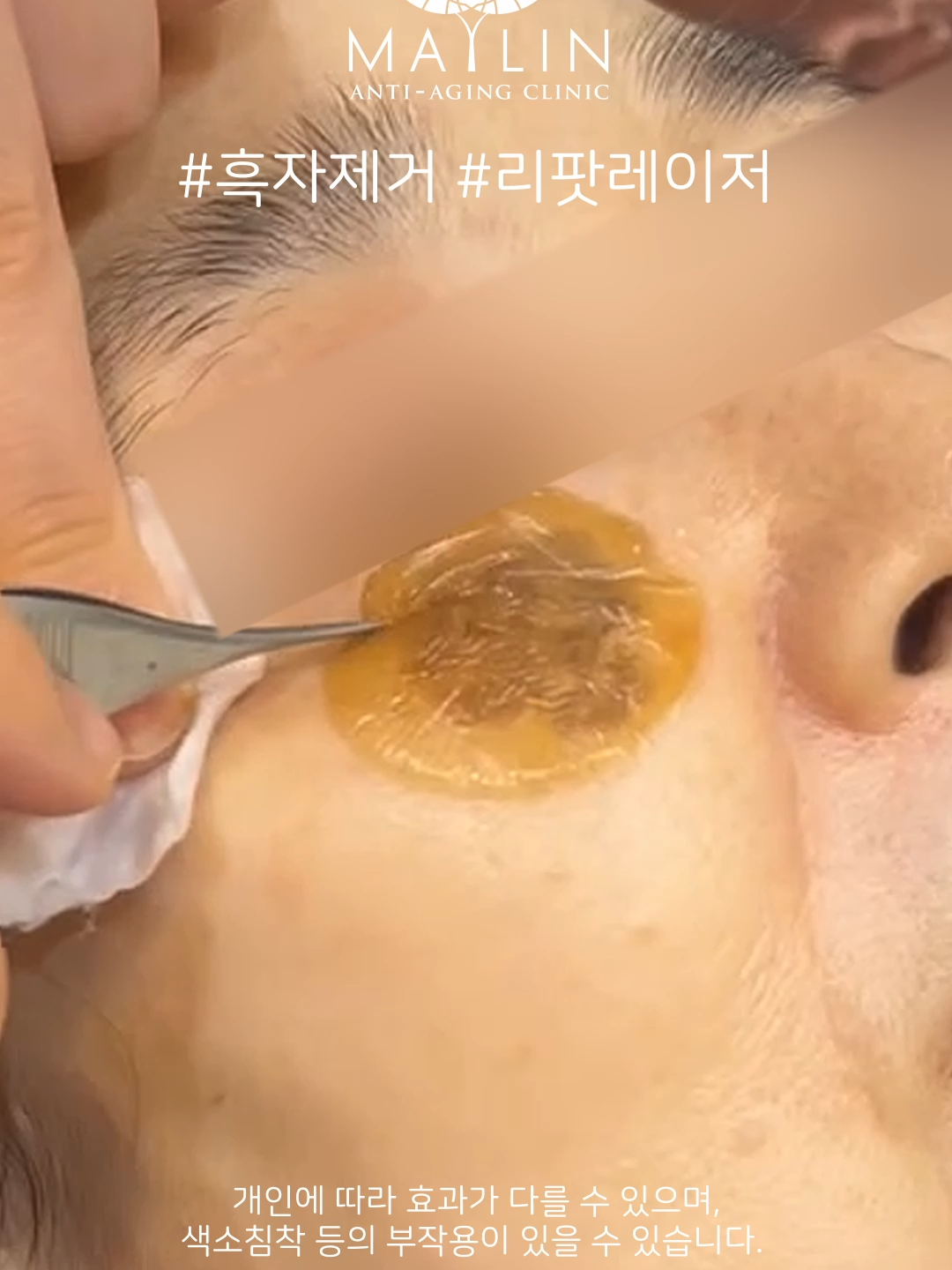 @메이린의원대구점