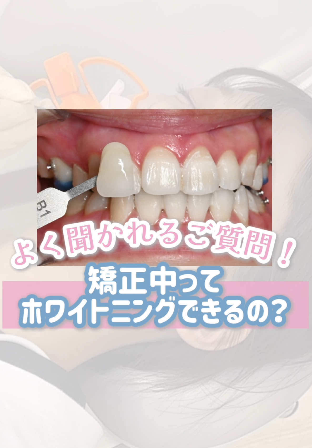 @新宿南口矯正歯科