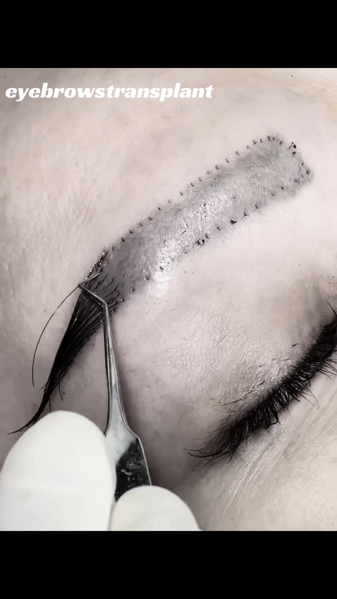 @Eyebrows Transplant
