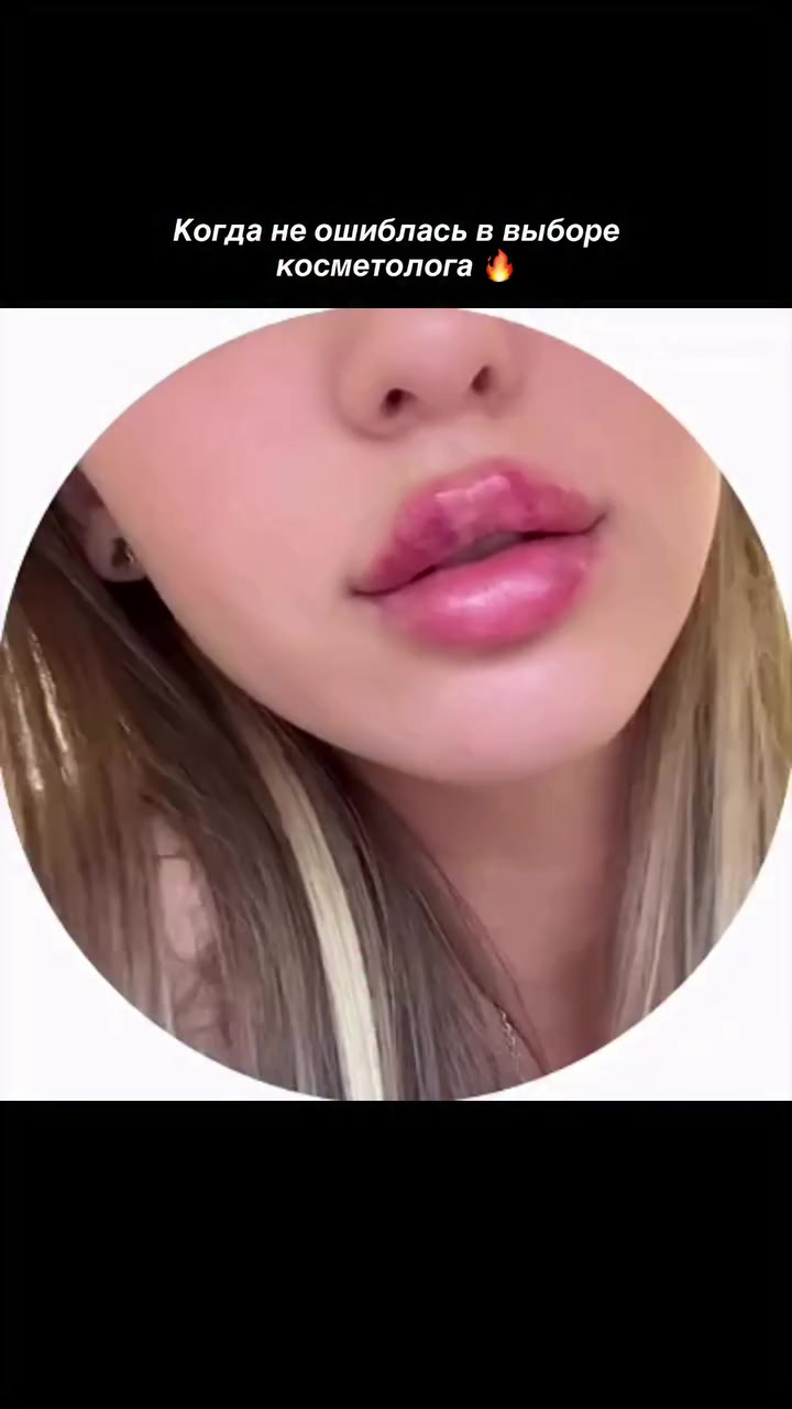 @КОСМЕТОЛОГ &bull; УВЕЛИЧЕНИЕ ГУБ