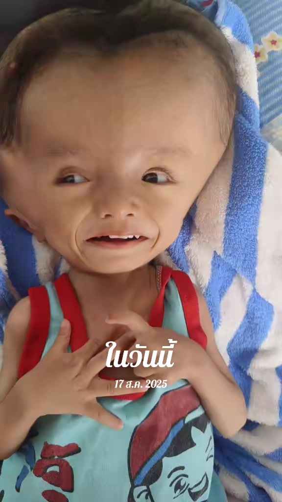 @บู้บี้เด็กหัวโตมีน้ำในโพรงสมอง