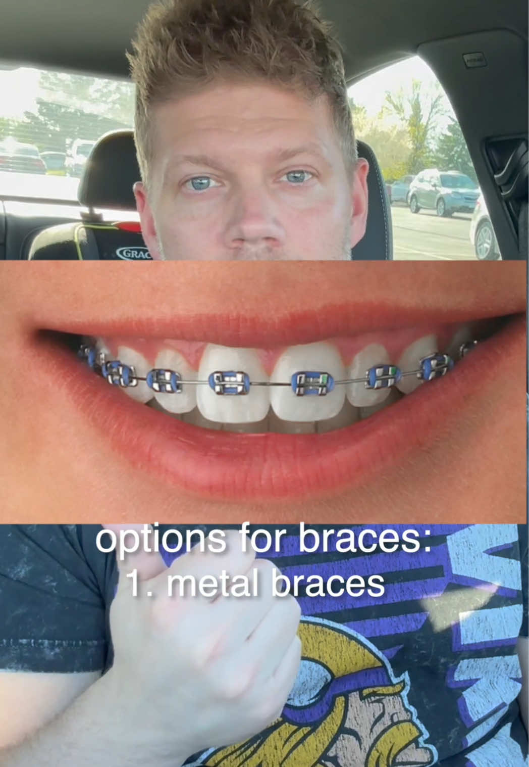 @The Braces Guy