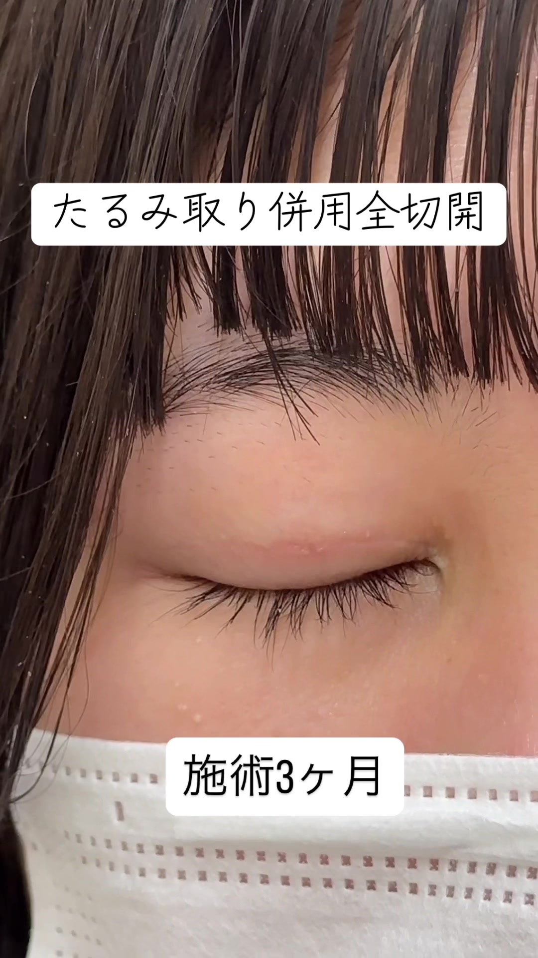 @二重整形埋没法/広島美容外科メイプルクリニック院長 吉本如良