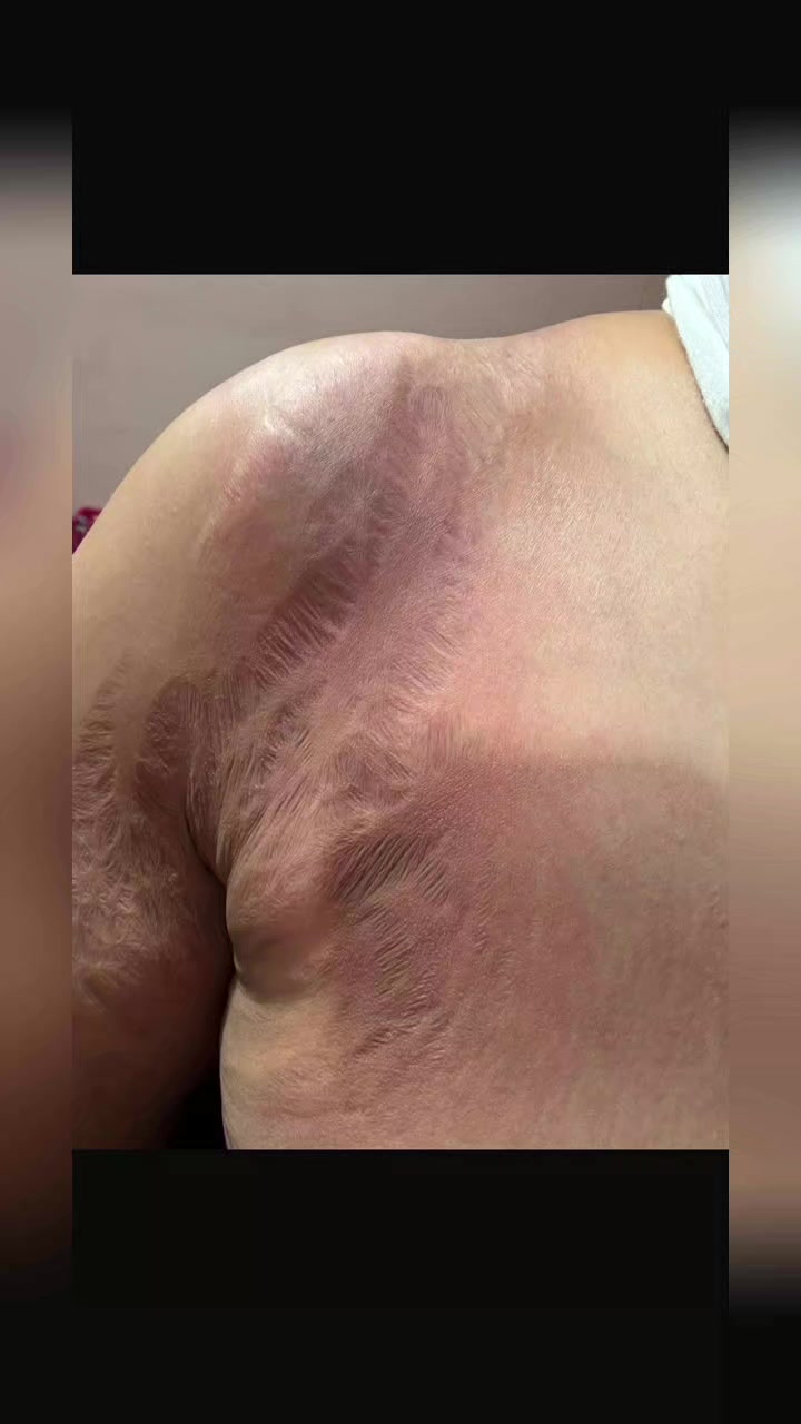 @drmanal " لعلاج التشققات "