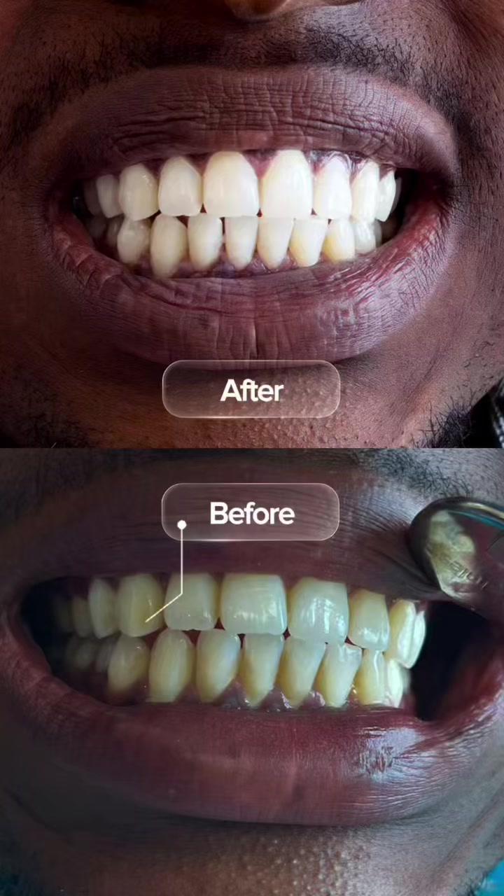 @Whiten Lighten TAC