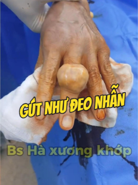 @Chuy&ecirc;n gia xương khớp