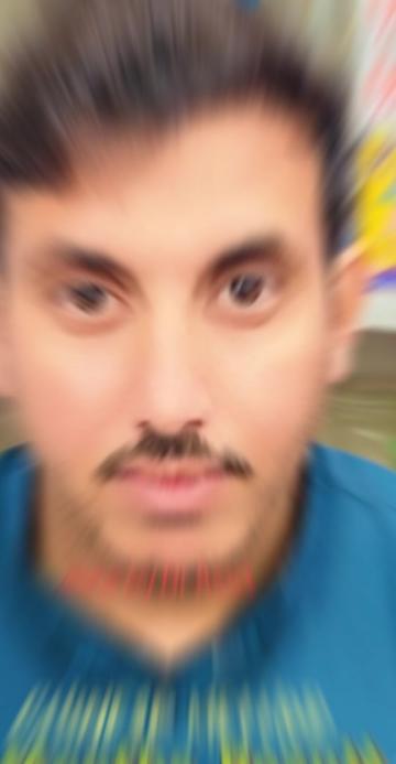 @Dr Asad shalman HairTransplant