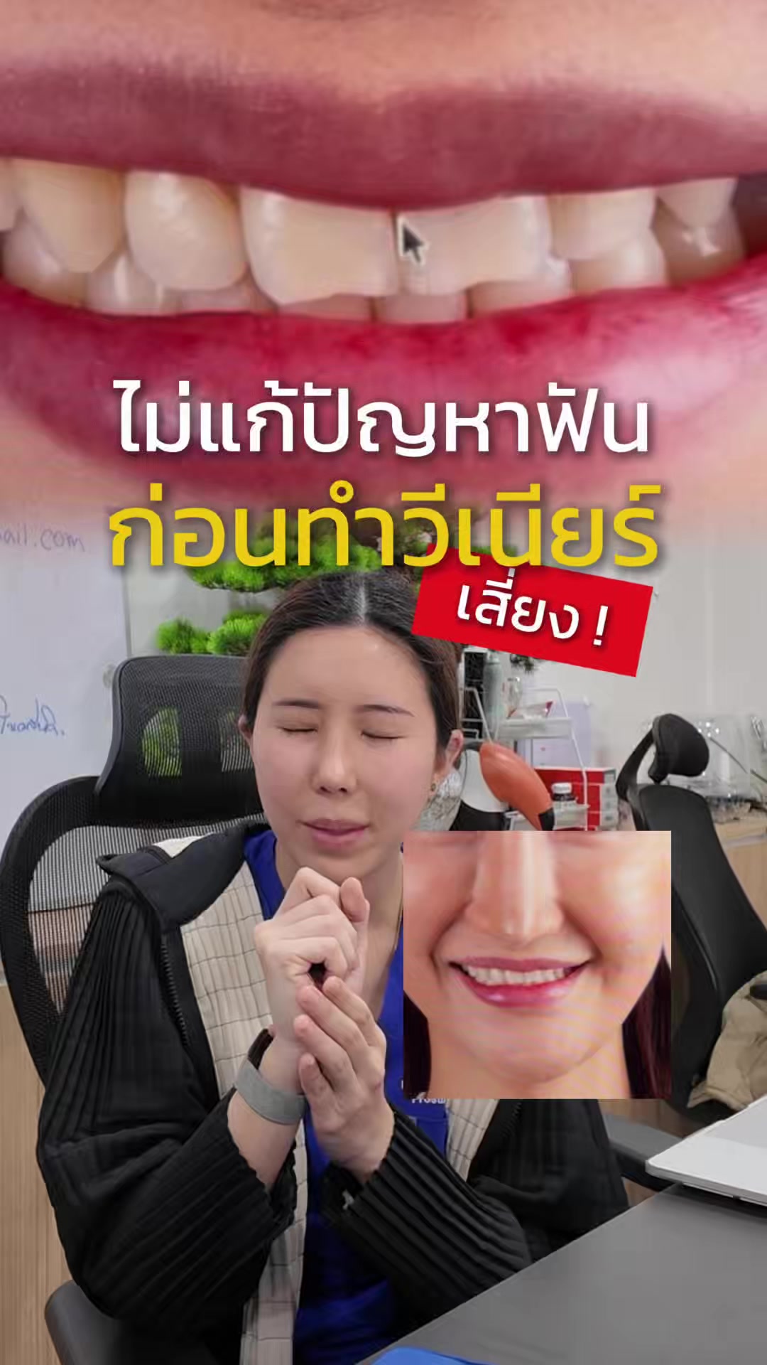 @หมอป่องสวยมาก veneer 🦷