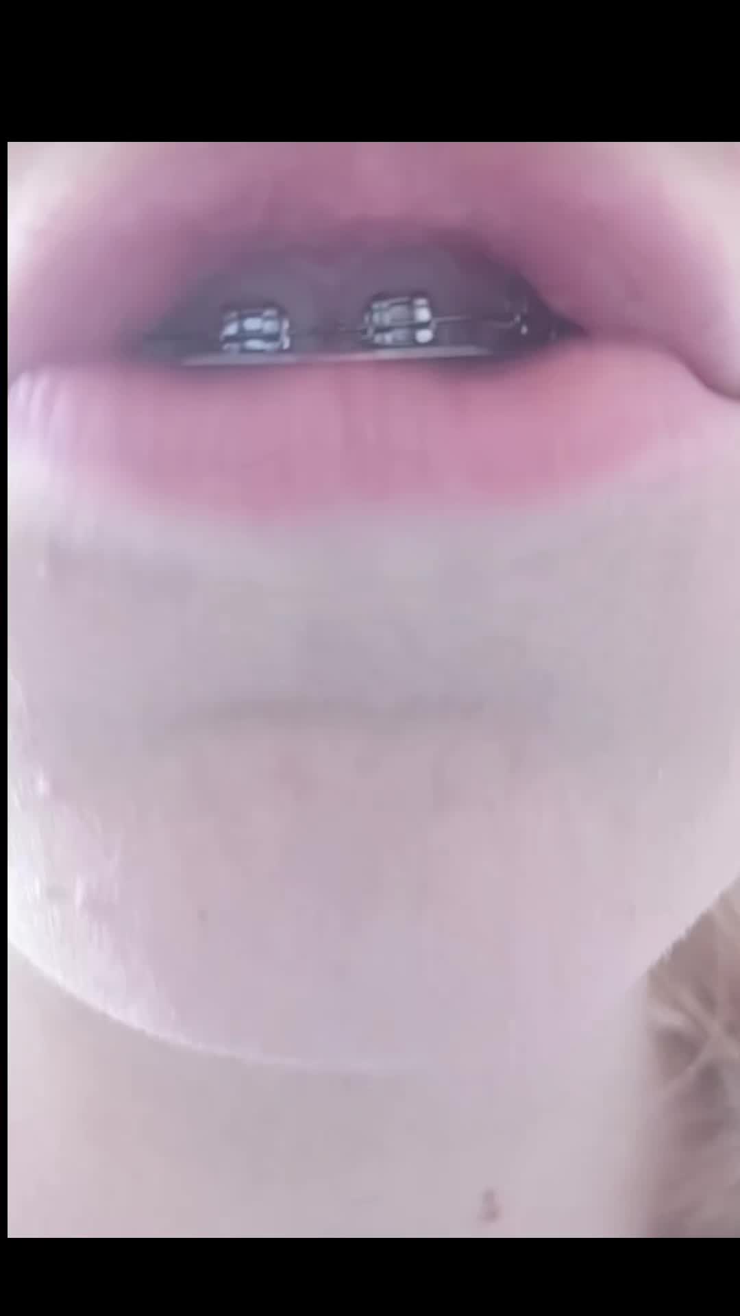 @Zahnspangen Club/  Braces Site