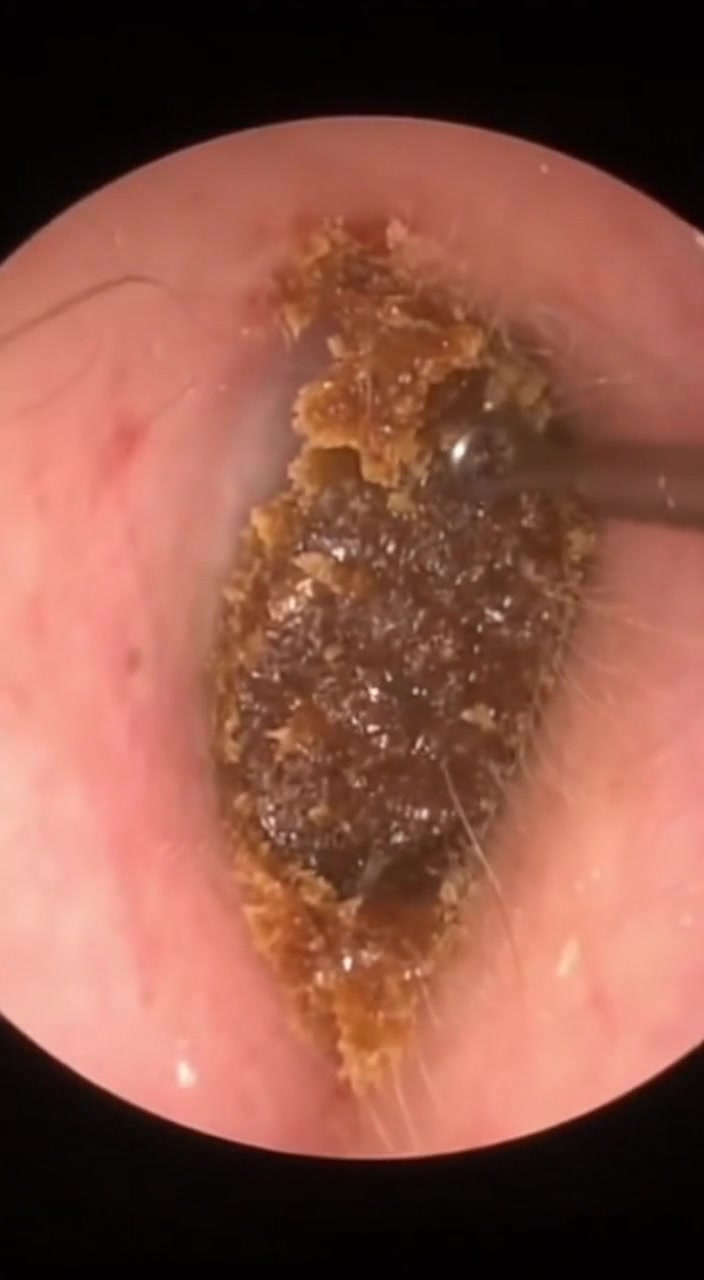 @Ear Cleaning
