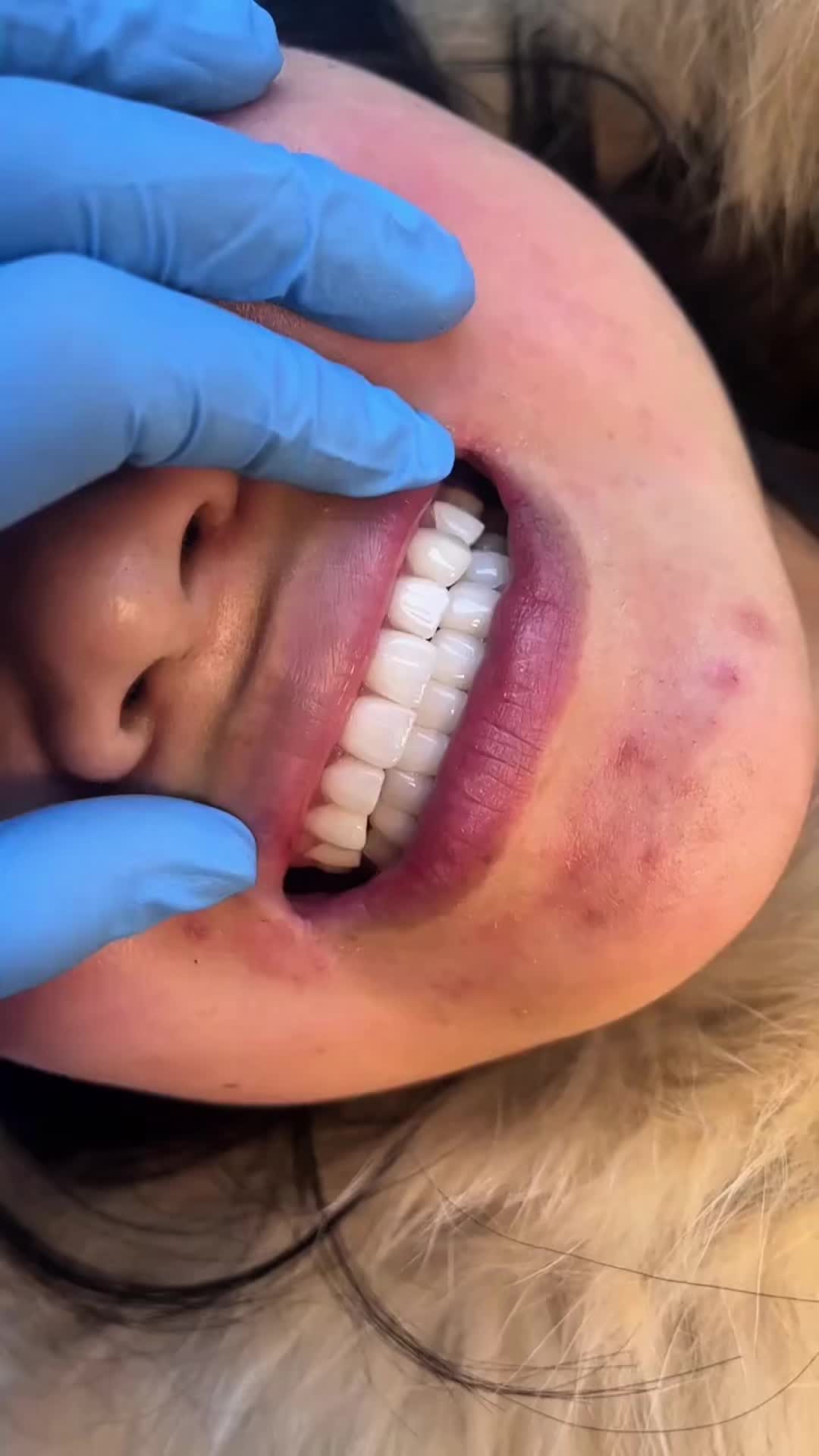 @HAIR TRANSPLANT WANG🇨🇳