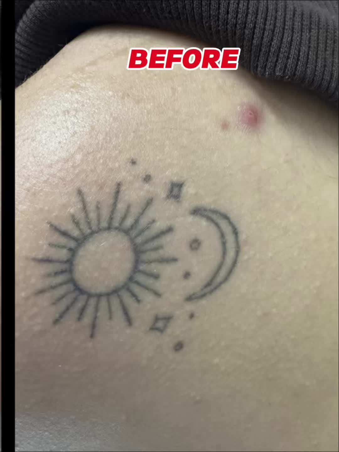 @Zeiva laser /Dearborn MI