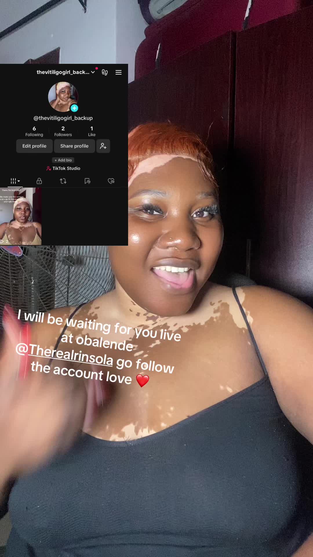 @Thevitiligogirl