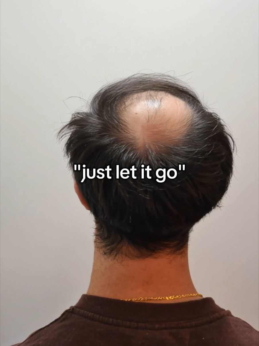 @Amit | Hair Transplant Tips