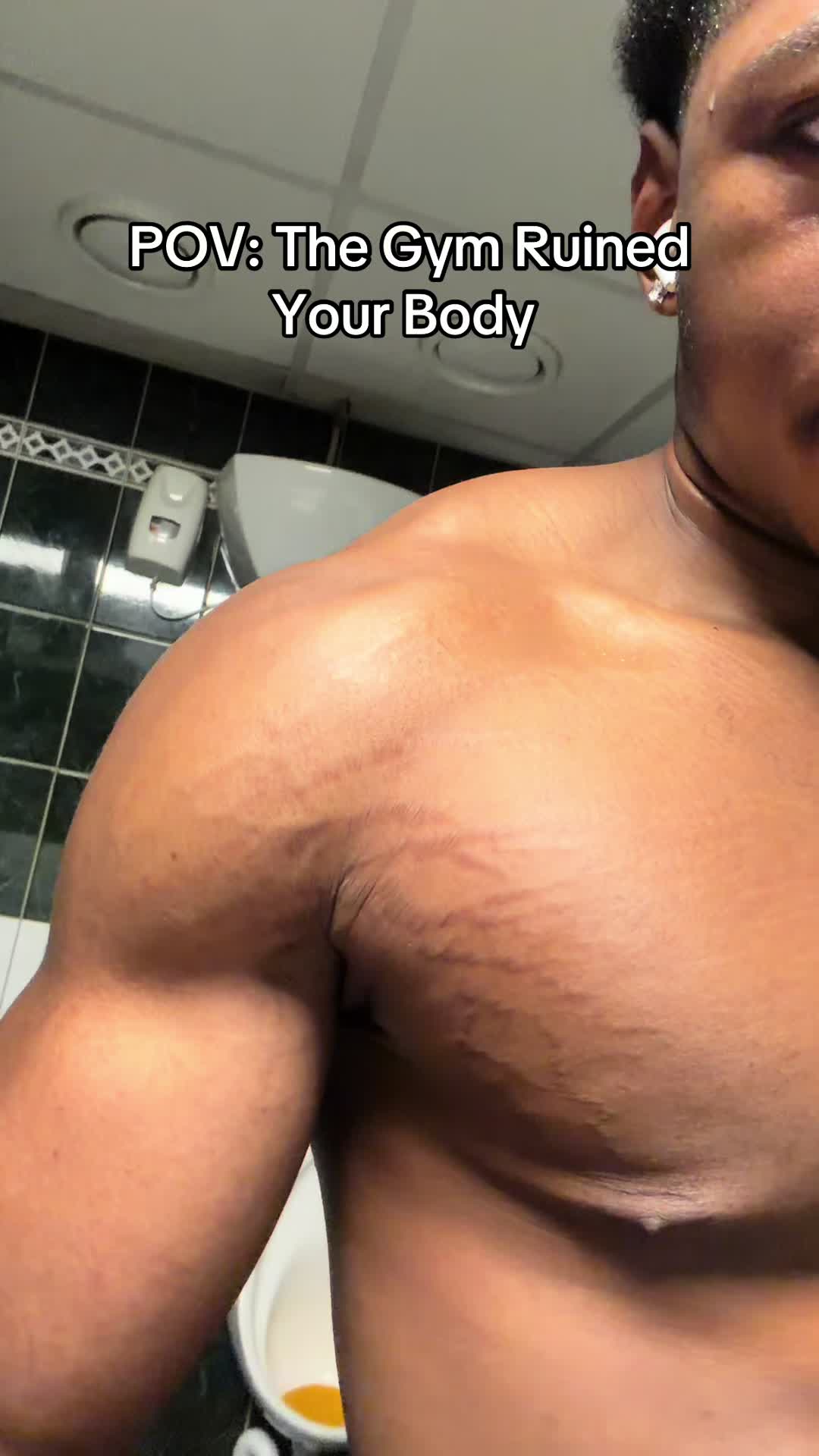@Stretch marks guy