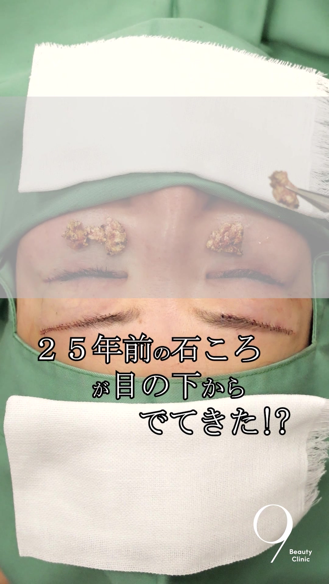 @りく先生　目元切開/クマ治療