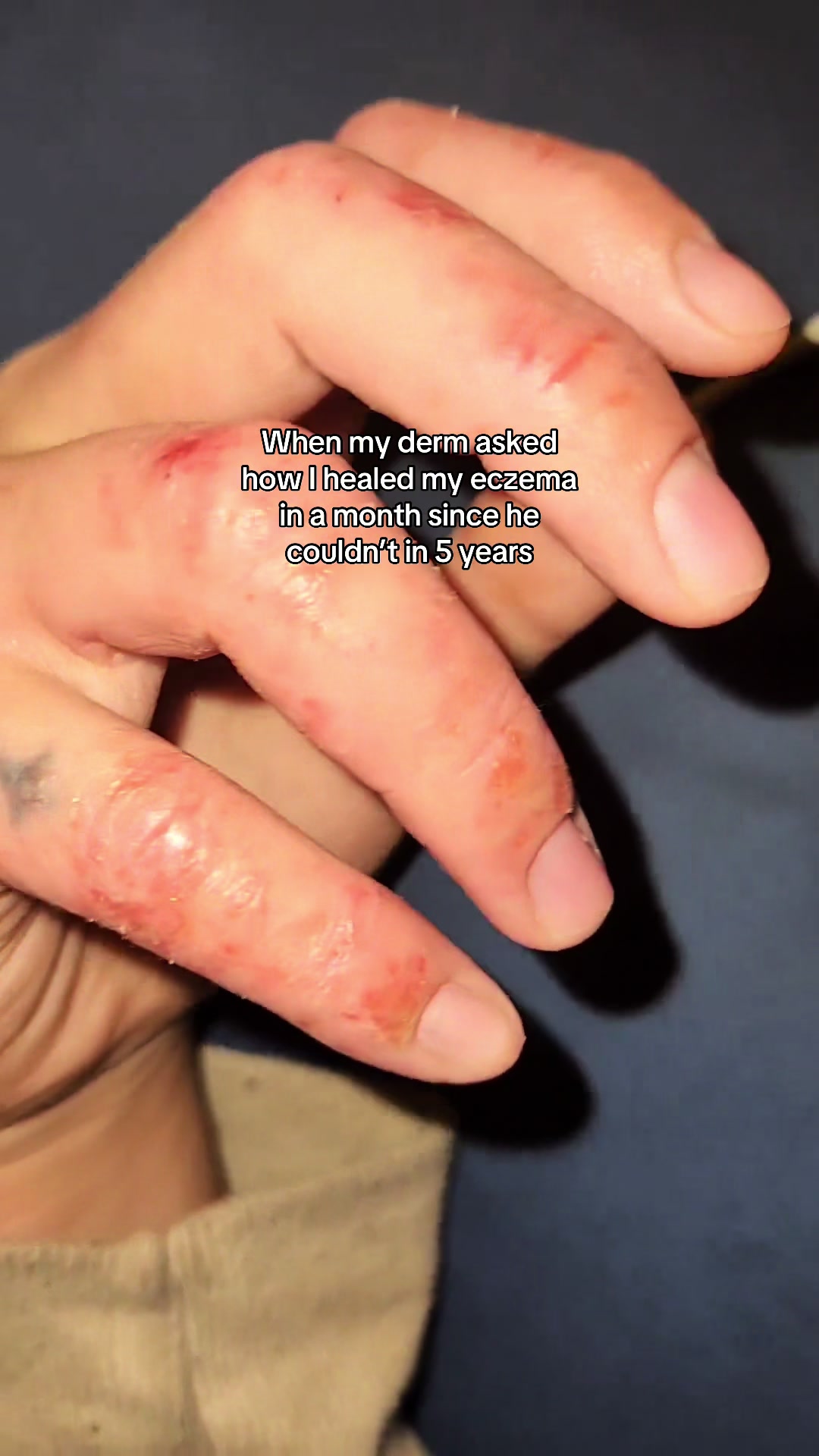 @Eczema Diaries USA & UK