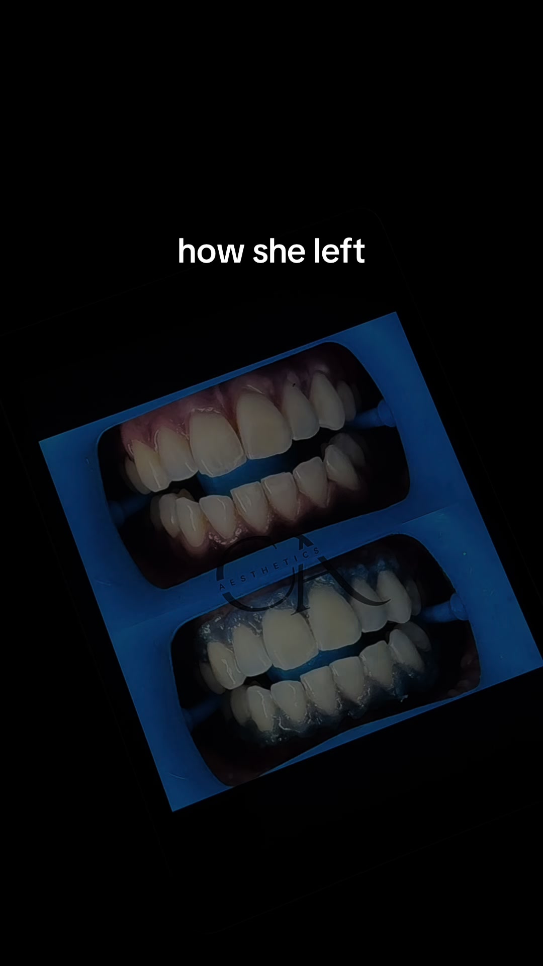 @Halal Teeth Whitening London