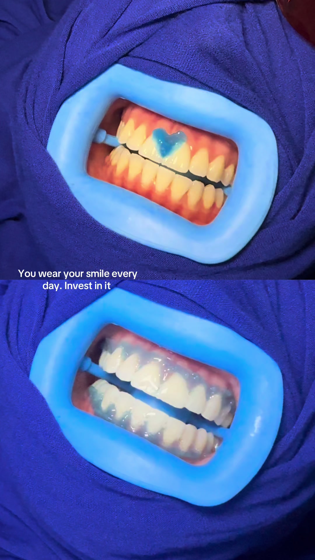@Halal Teeth Whitening London