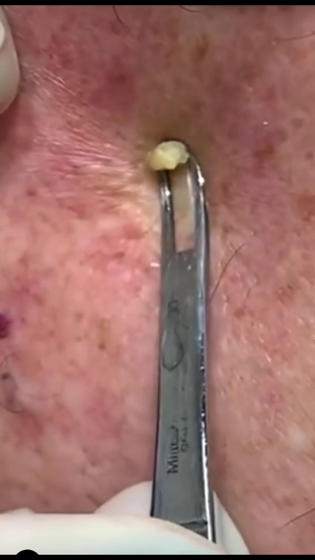 @pimplepopperasmr
