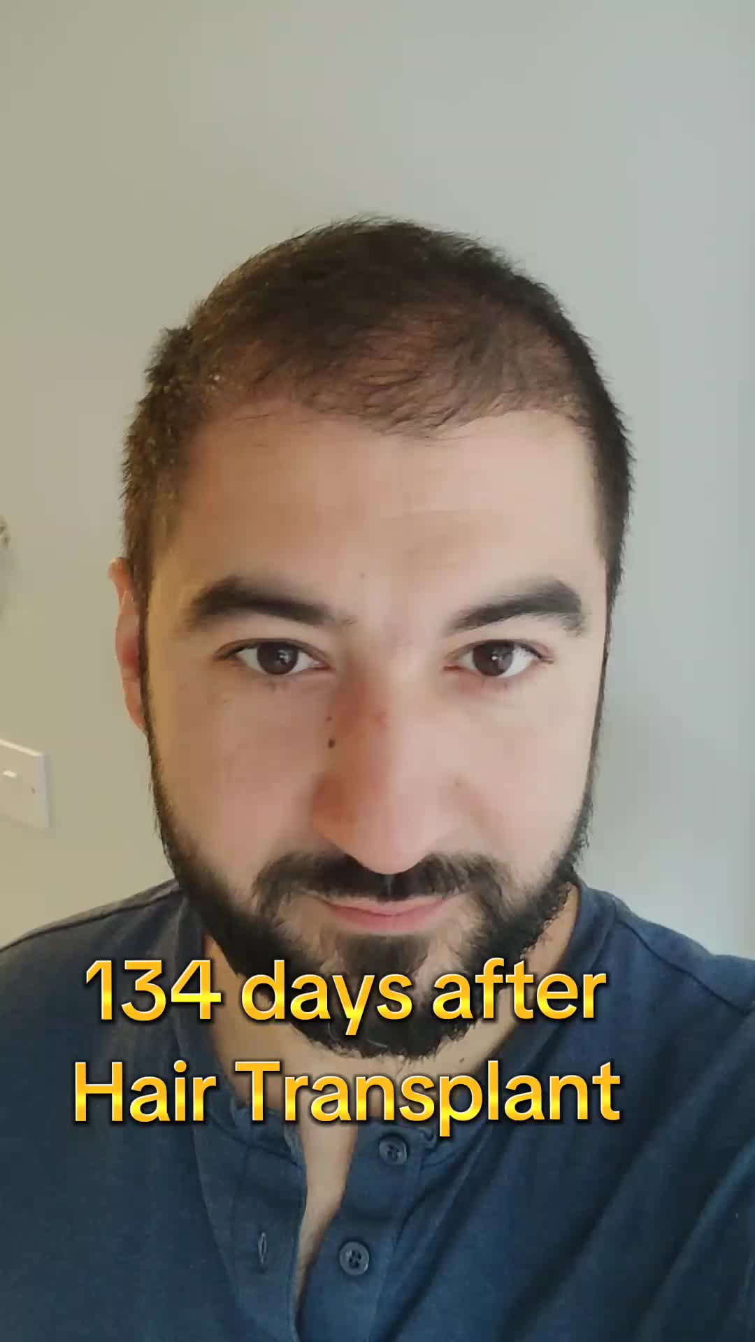 @My hair transplant