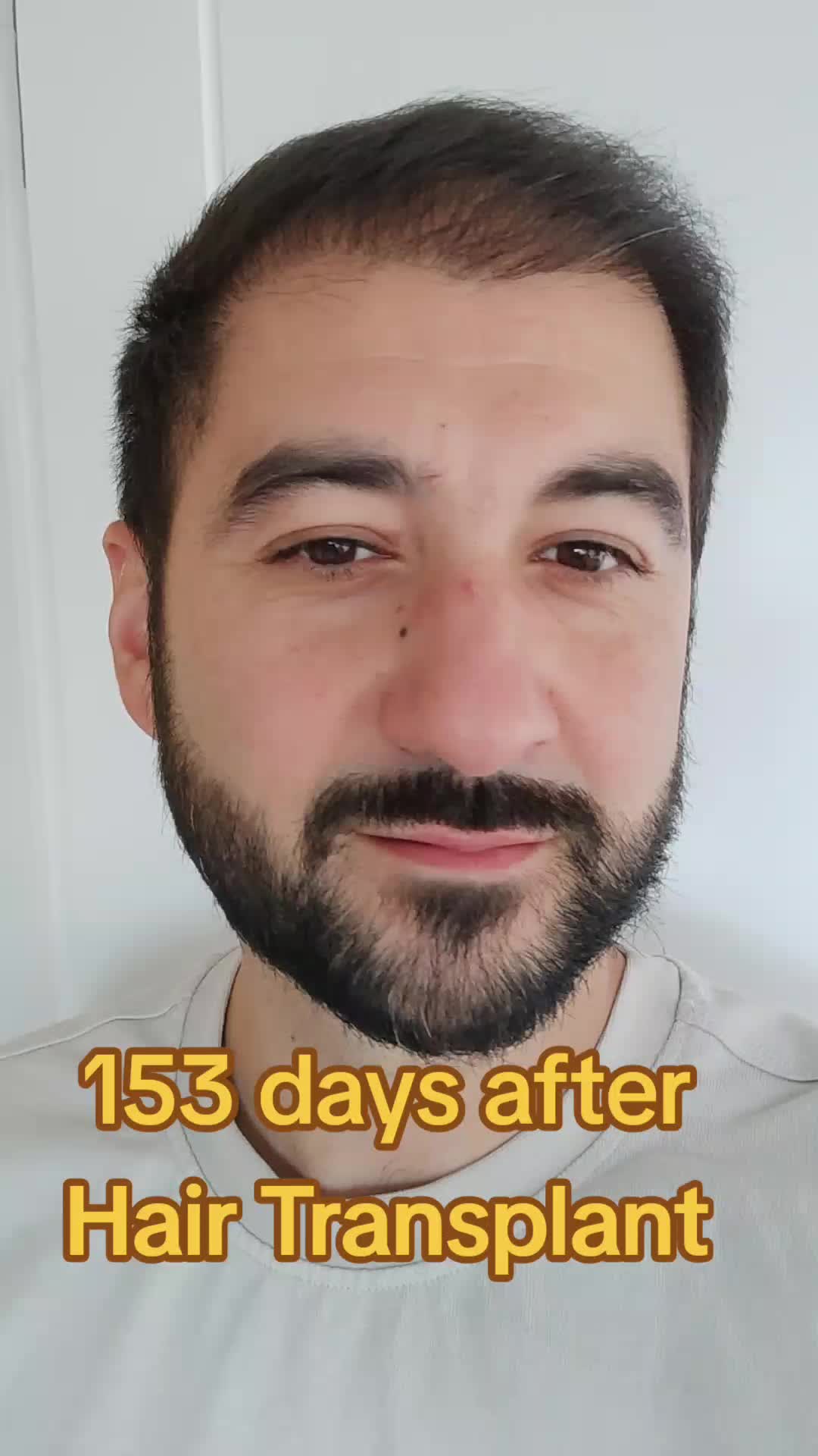 @My hair transplant