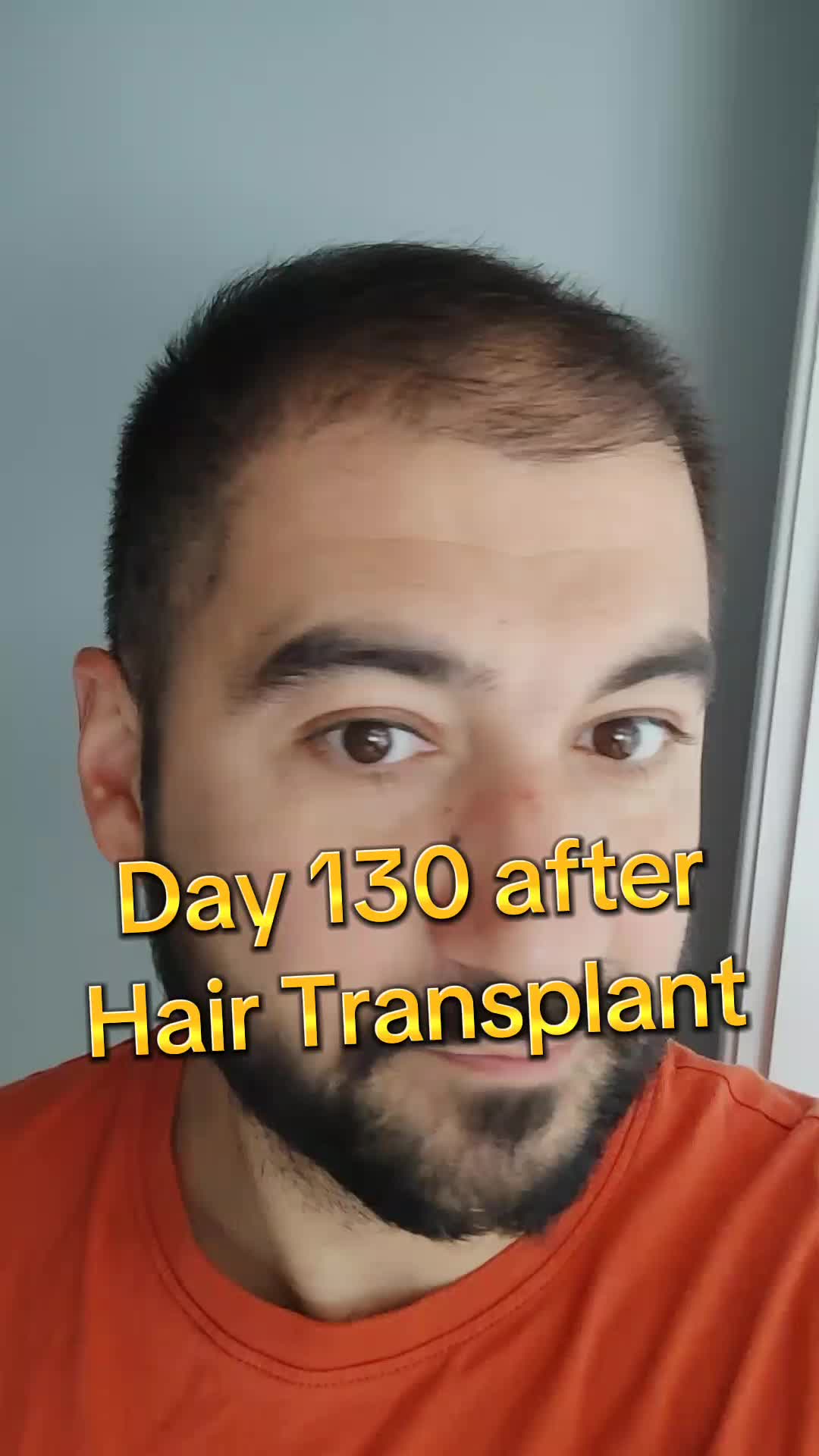 @My hair transplant