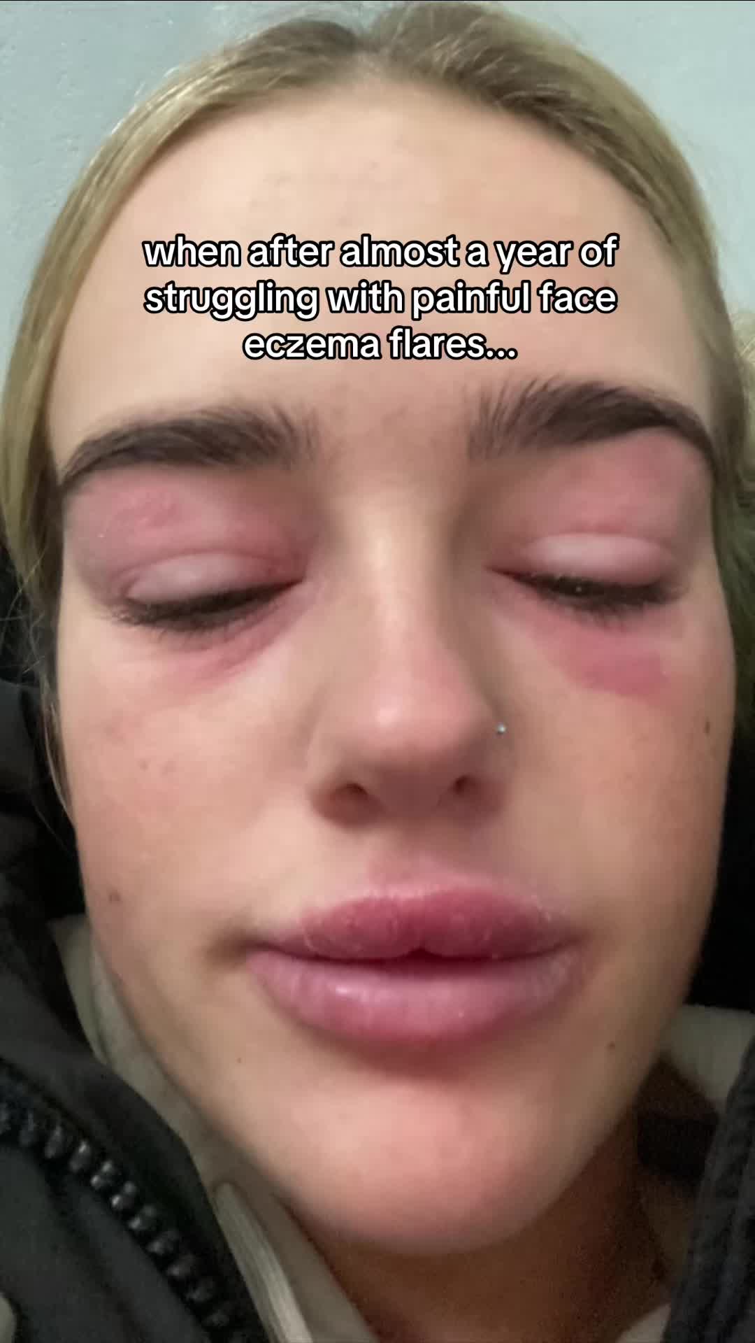 @Eczema Diaries USA & UK