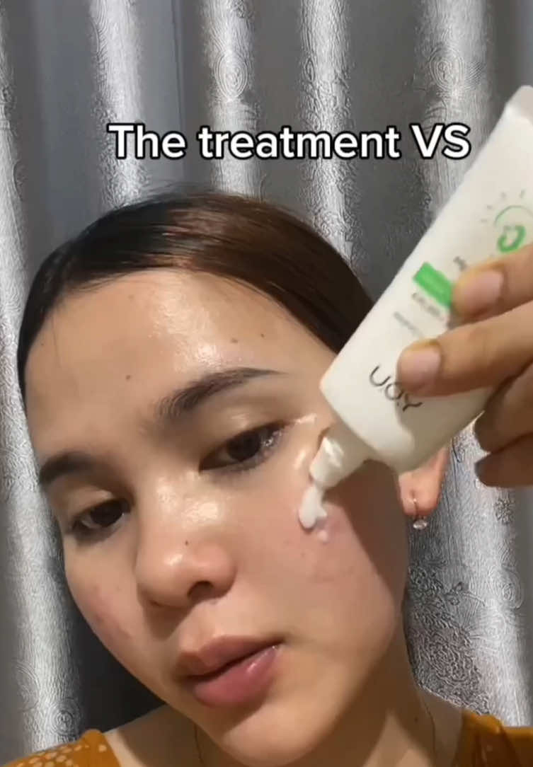 @Natha | Acne fighter