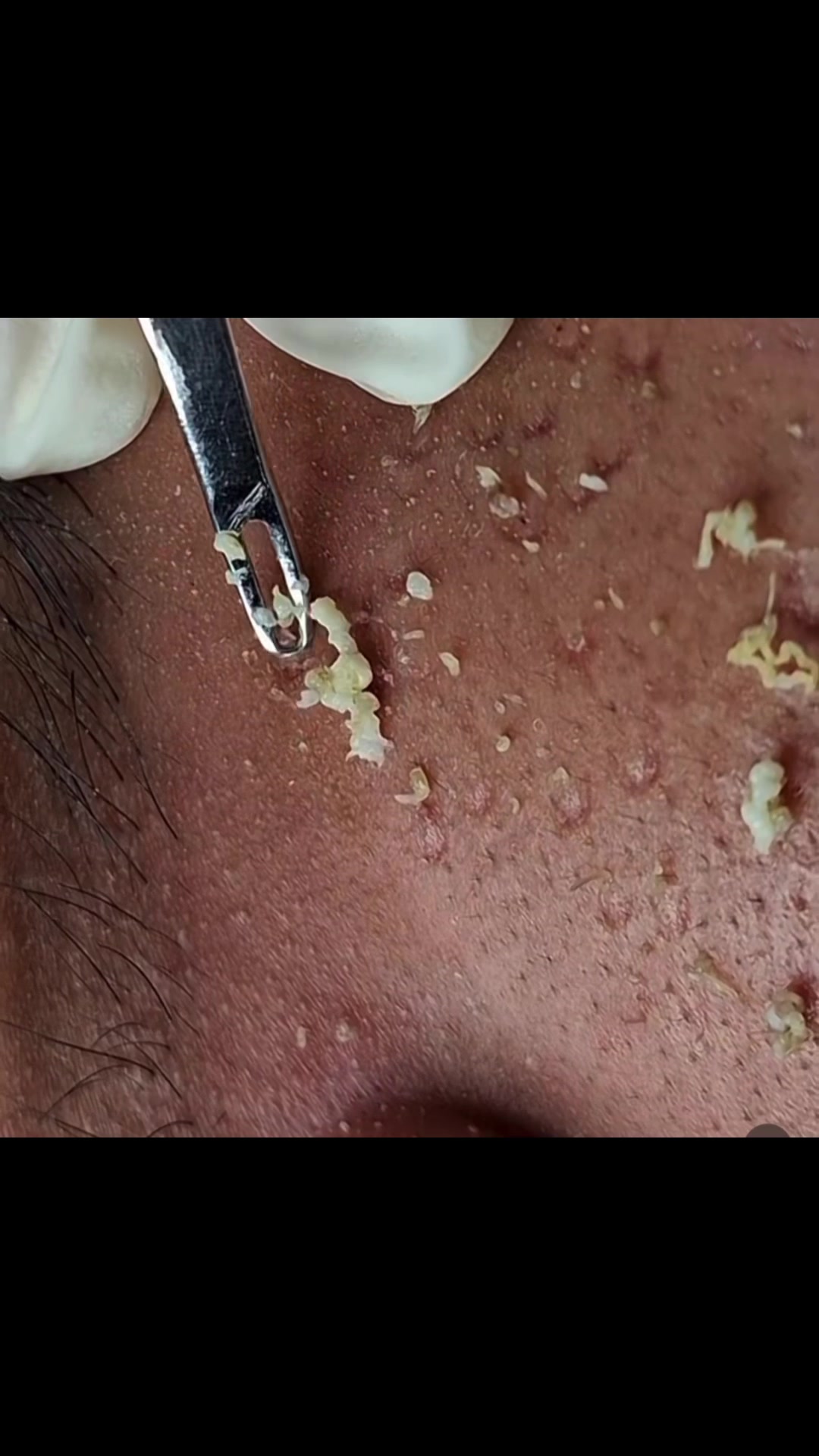 @pimplepopperasmr