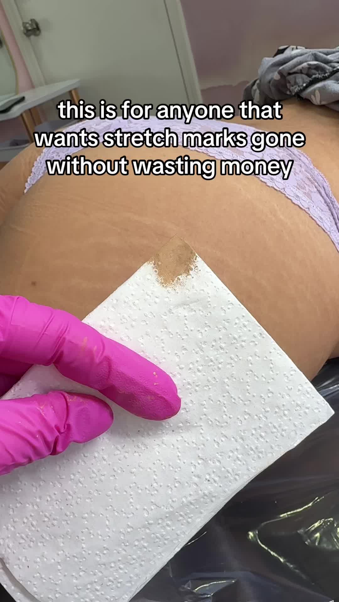 @Stretch Mark Fairy 🧚✨