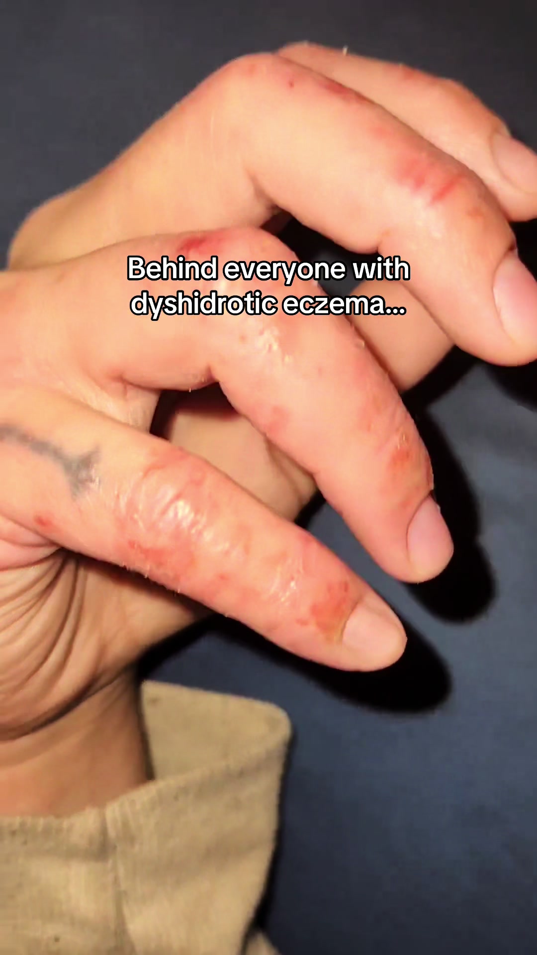 @Eczema Diaries USA & UK