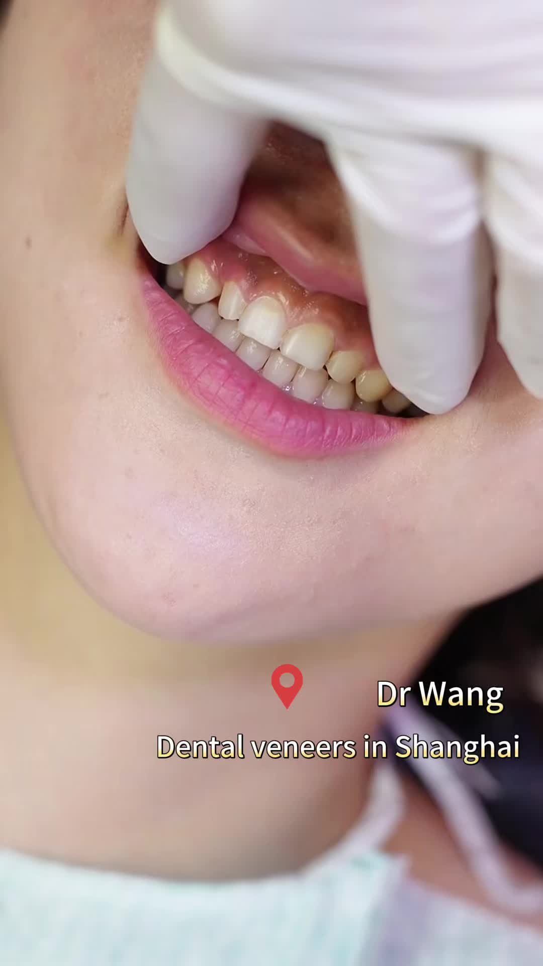 @HAIR TRANSPLANT WANG🇨🇳