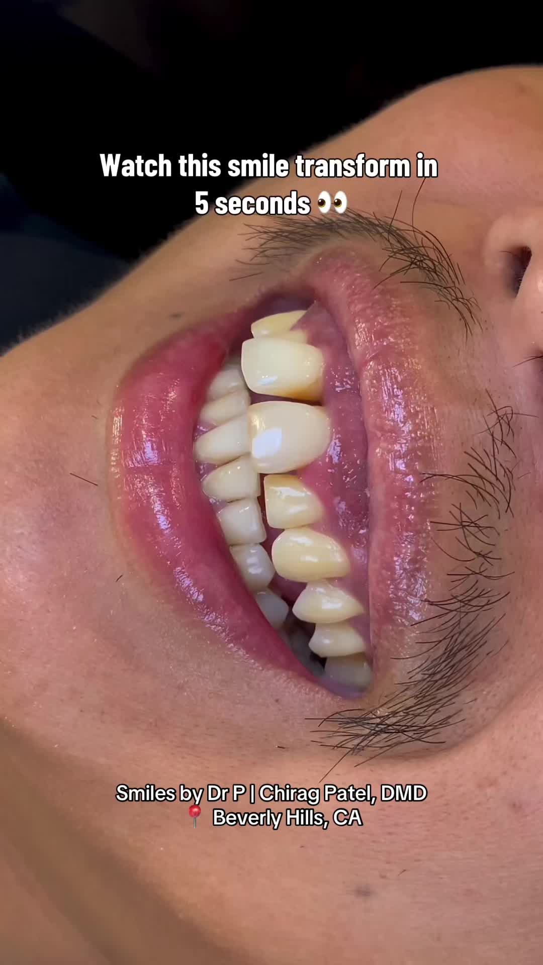 @Veneers