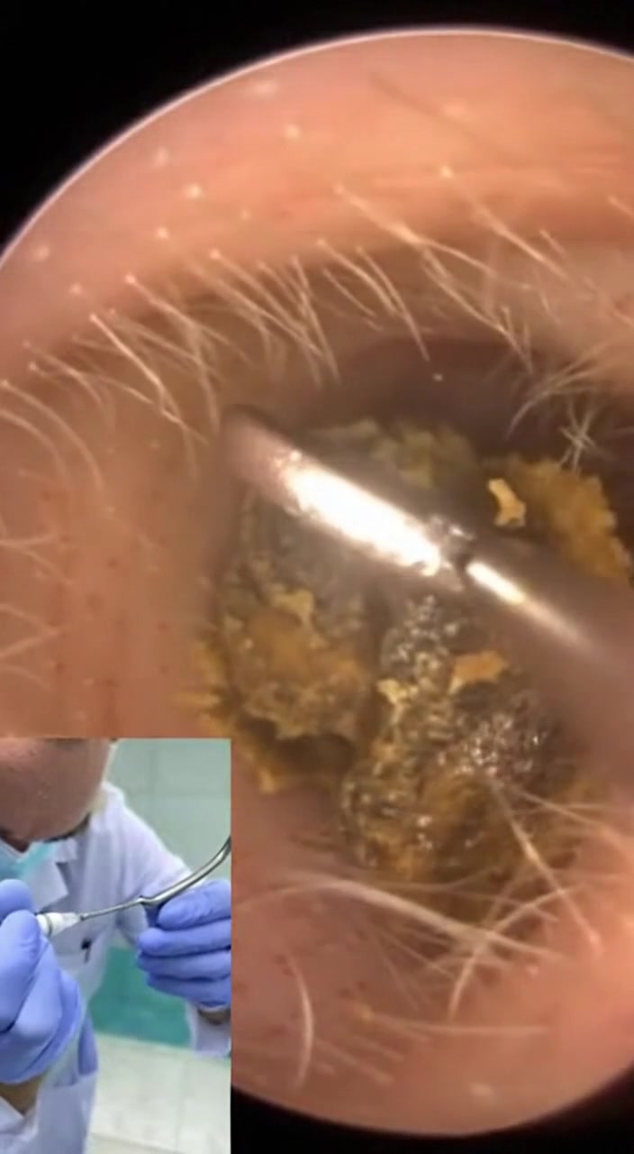 @Ear Cleaning