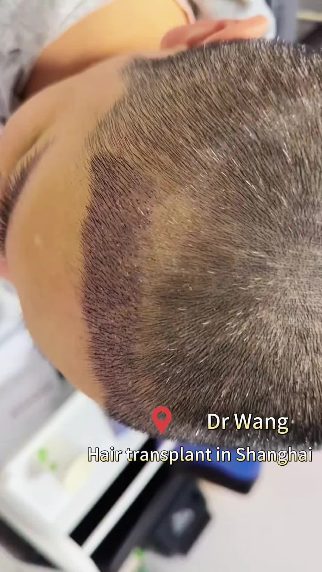 @HAIR TRANSPLANT WANG🇨🇳