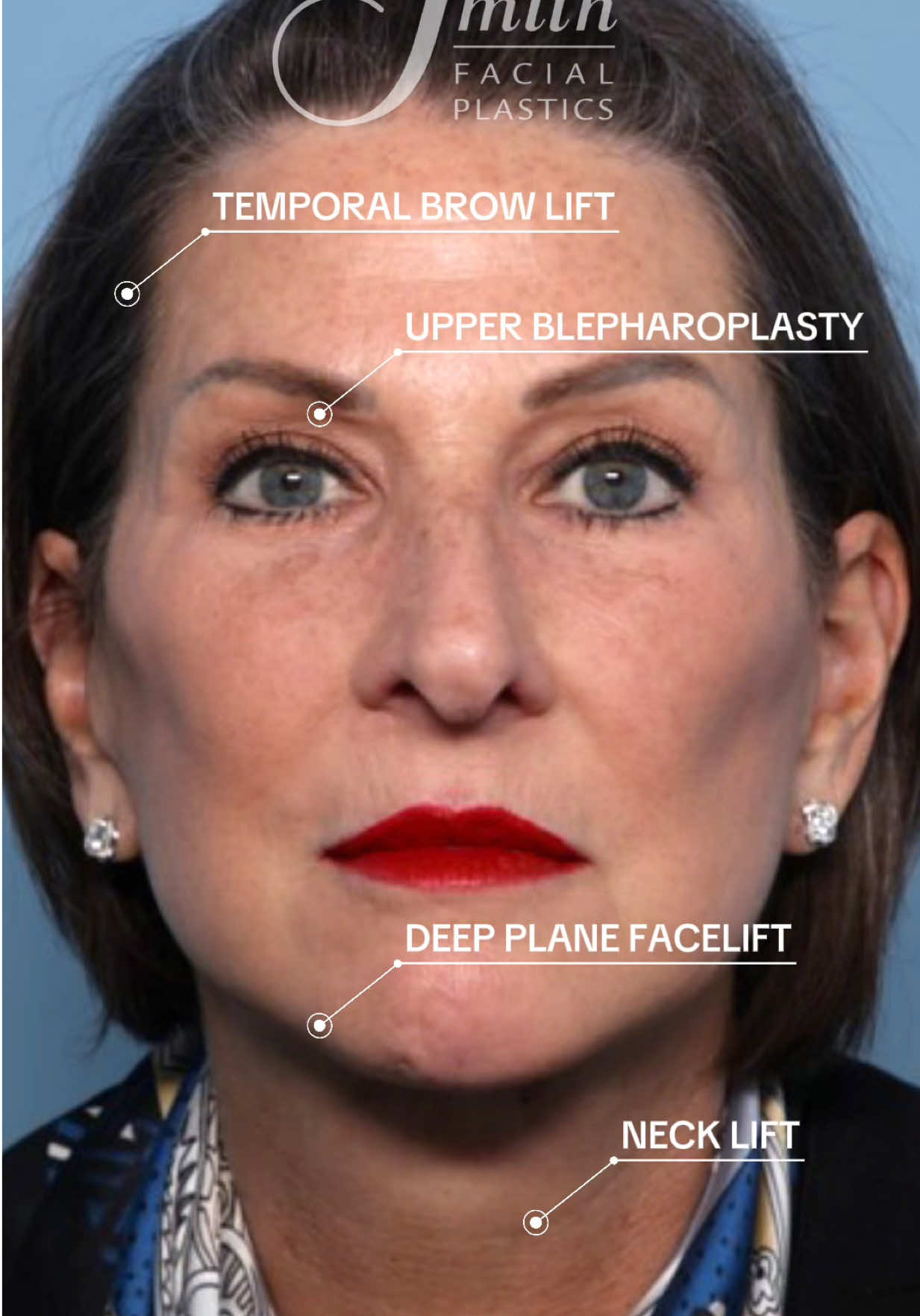 @Smith Facial Plastics
