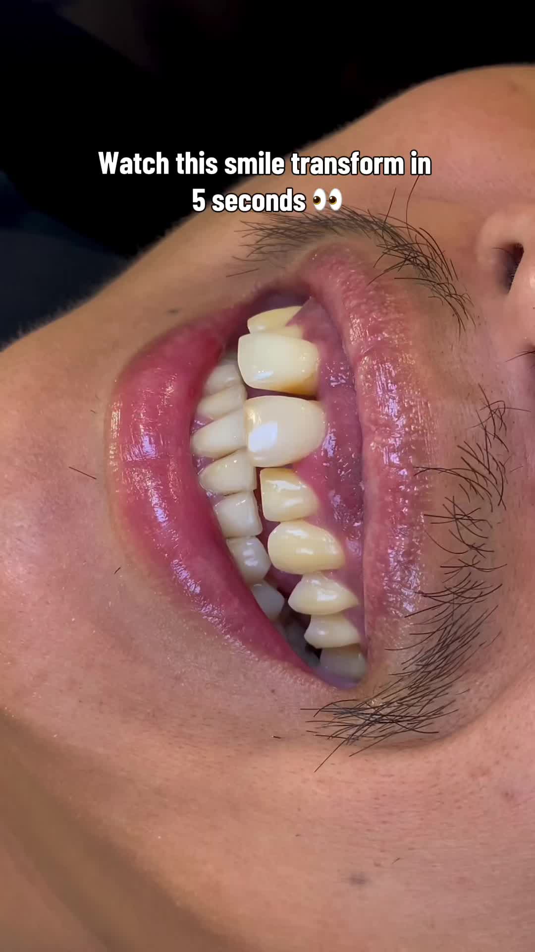 @Veneers
