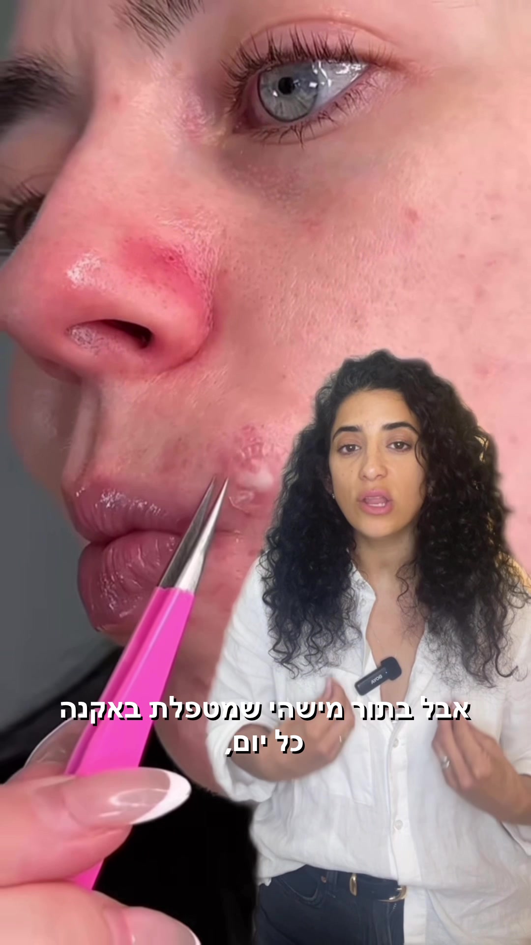 @תמר זריבץ - אקנה ופוסט אקנה