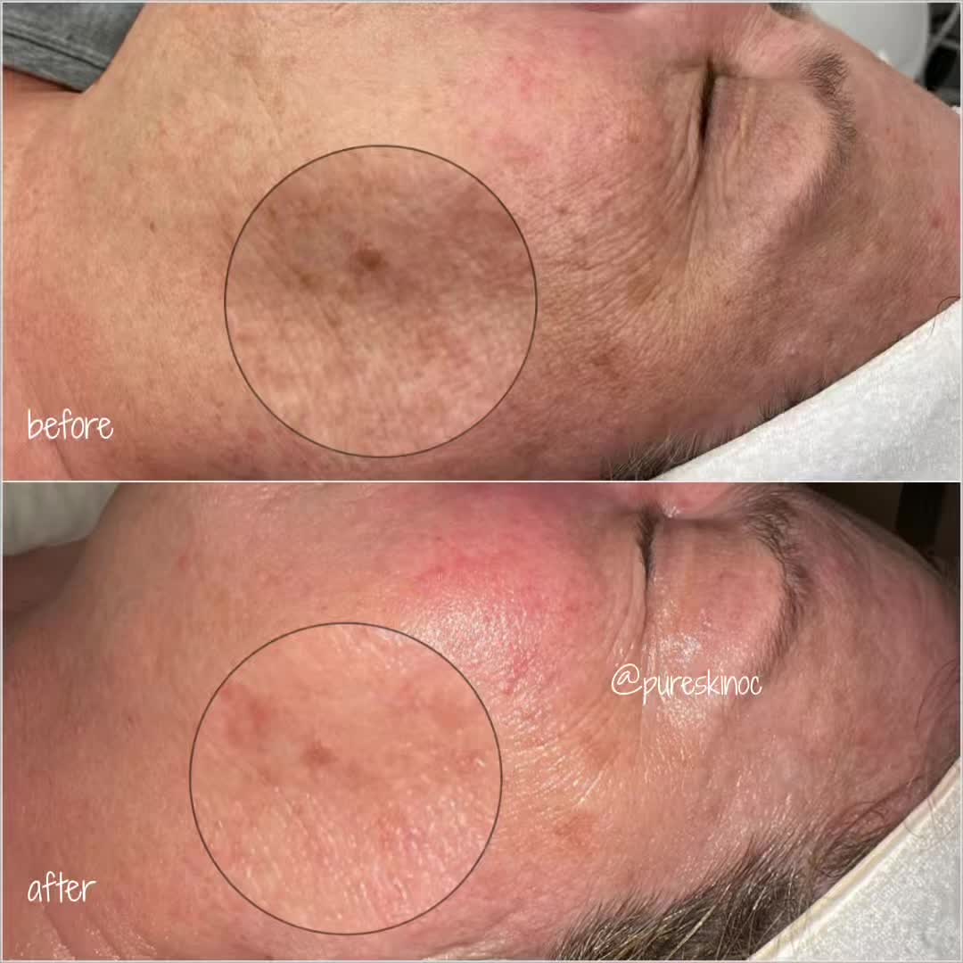 @Pure Skin OC