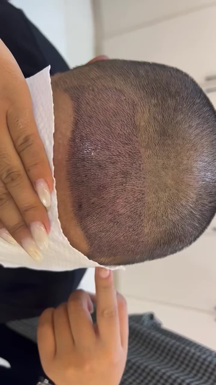 @HAIR TRANSPLANT WANG🇨🇳