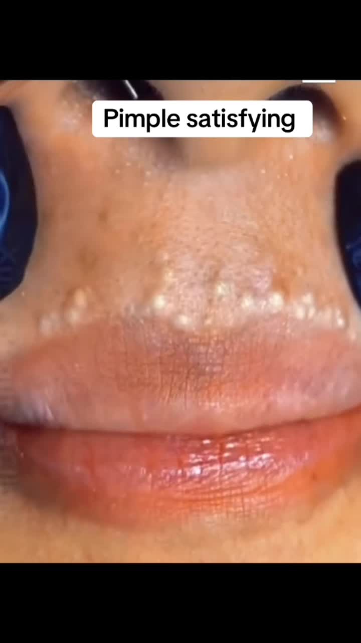 @Pimple Pooping