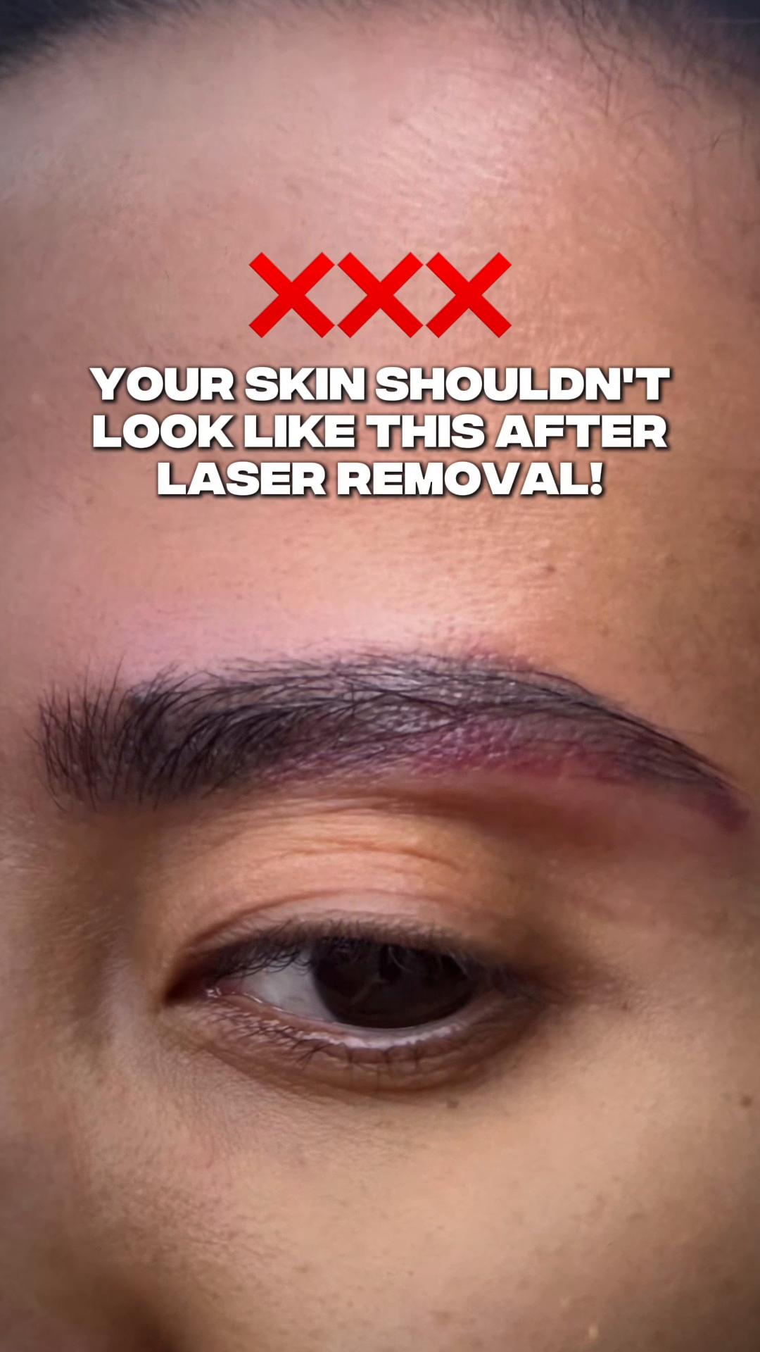 @Safe Eyebrows Tattoo Removal🗽