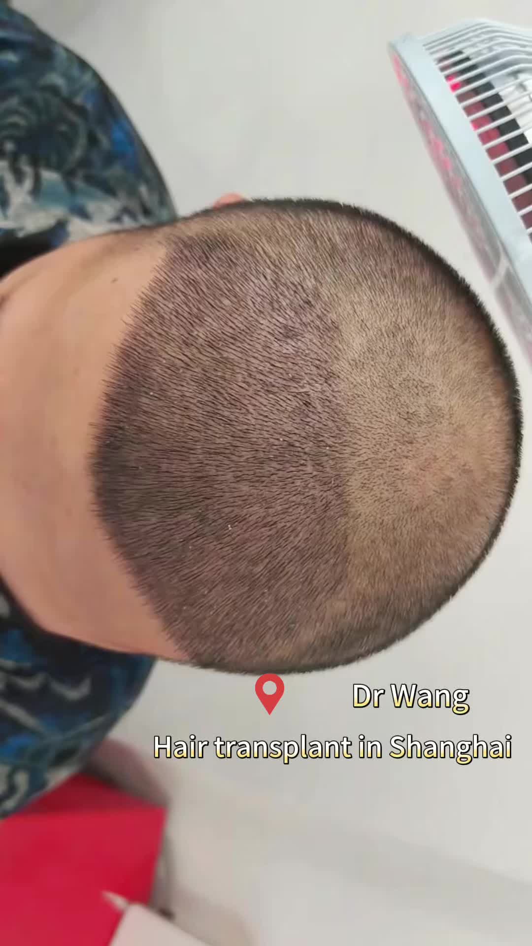 @HAIR TRANSPLANT WANG🇨🇳