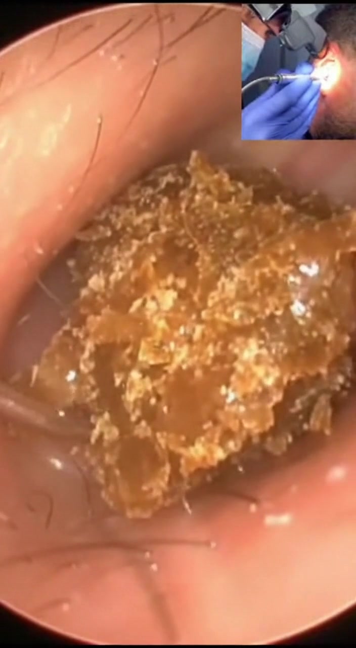 @Ear Cleaning